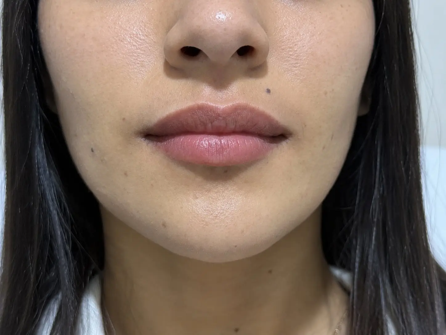 Aumento de labios: después del tratamiento