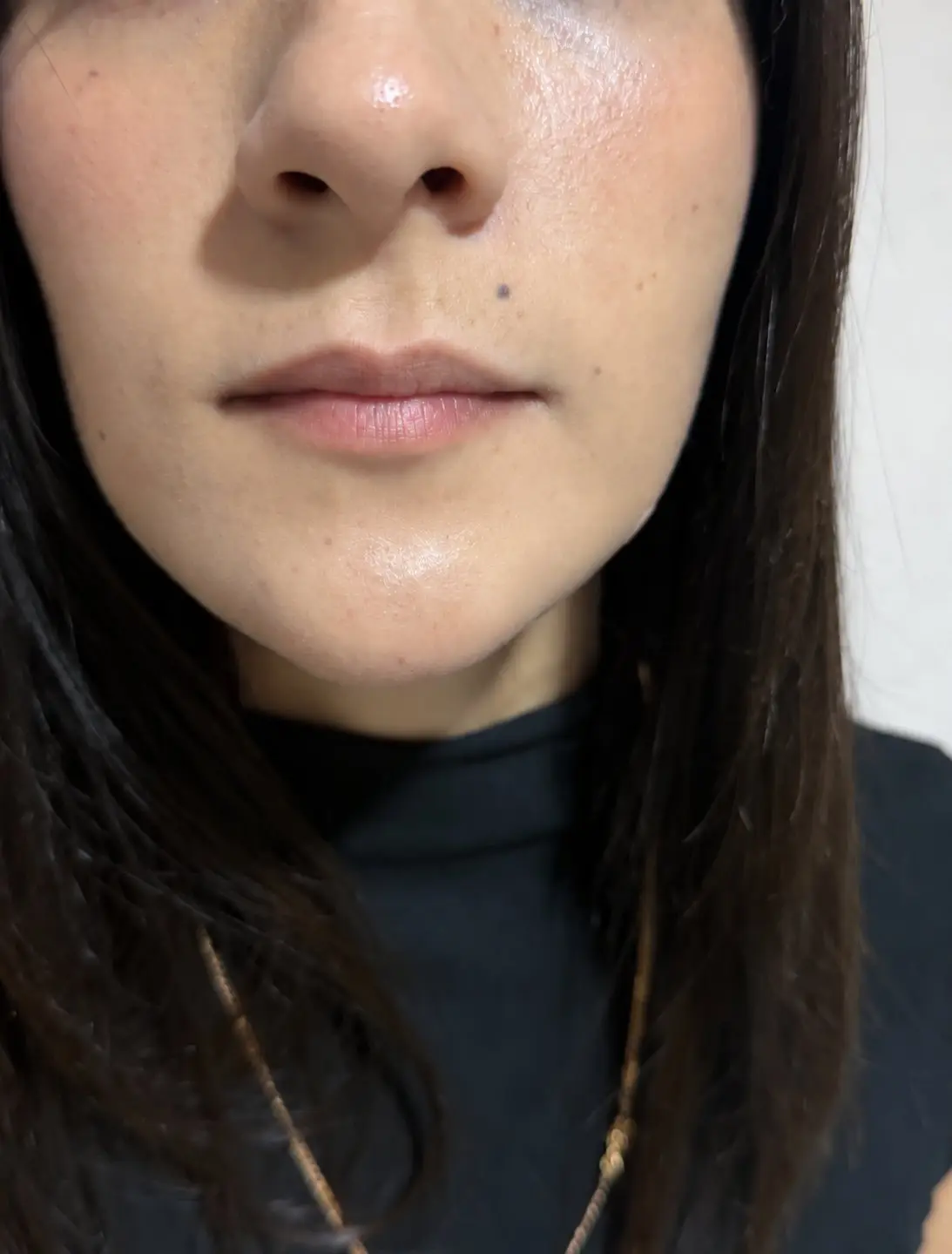 Aumento de labios: antes del tratamiento