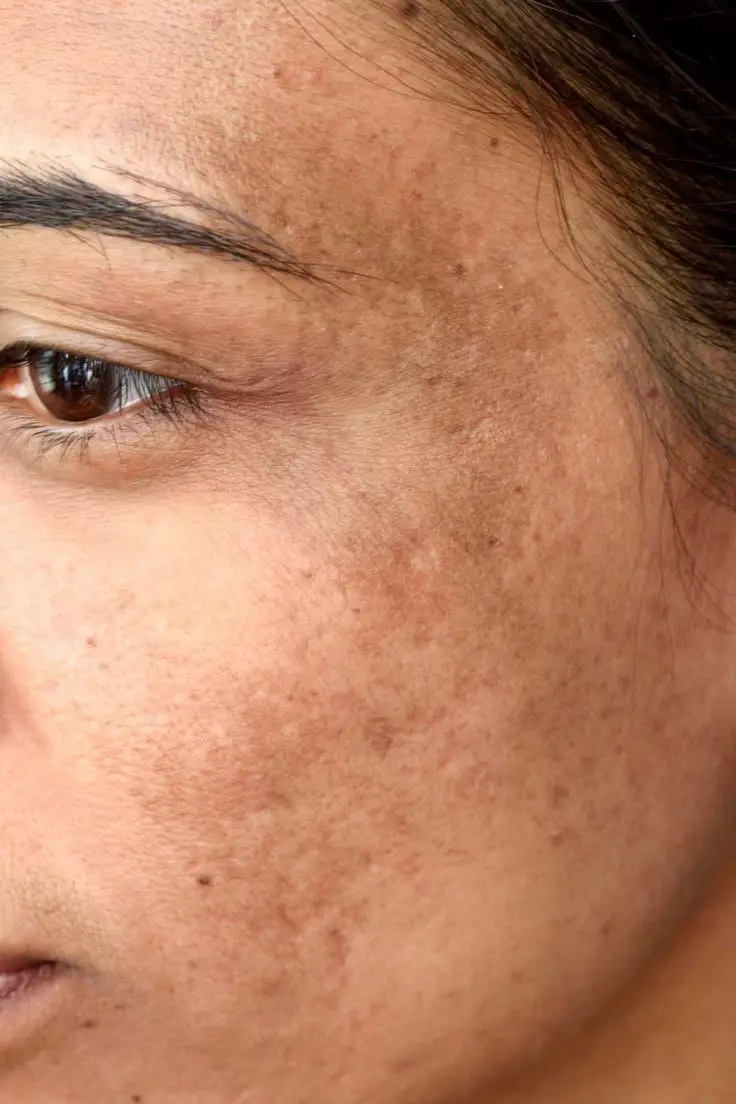 ¿Cómo tratar las manchas del rostro?