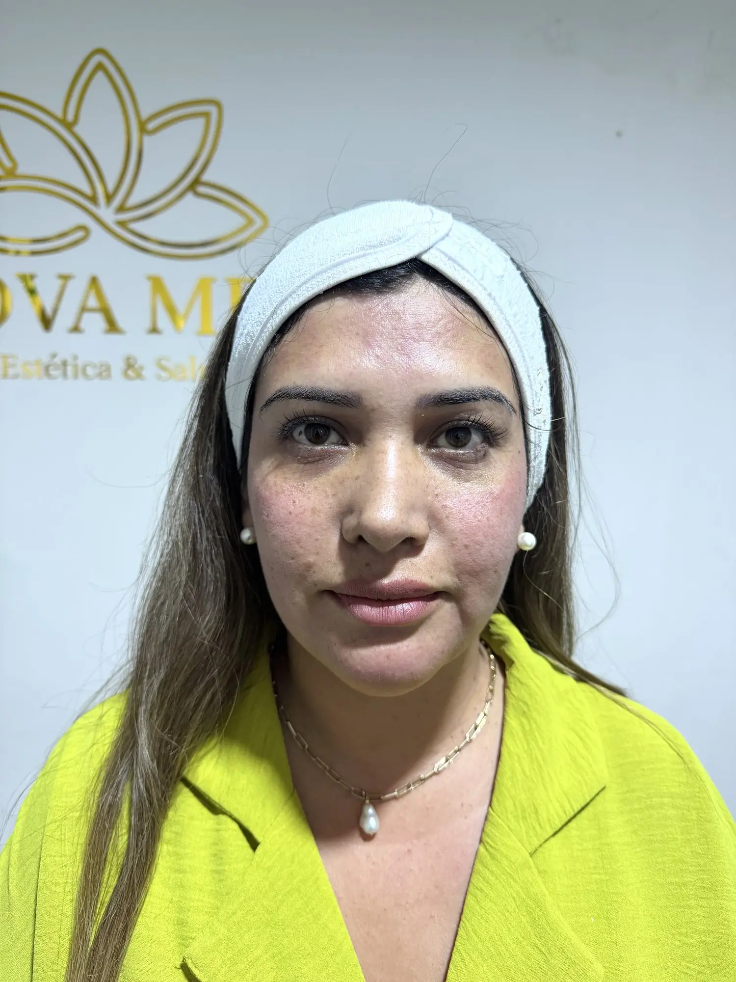 Morpheus facial: antes del tratamiento