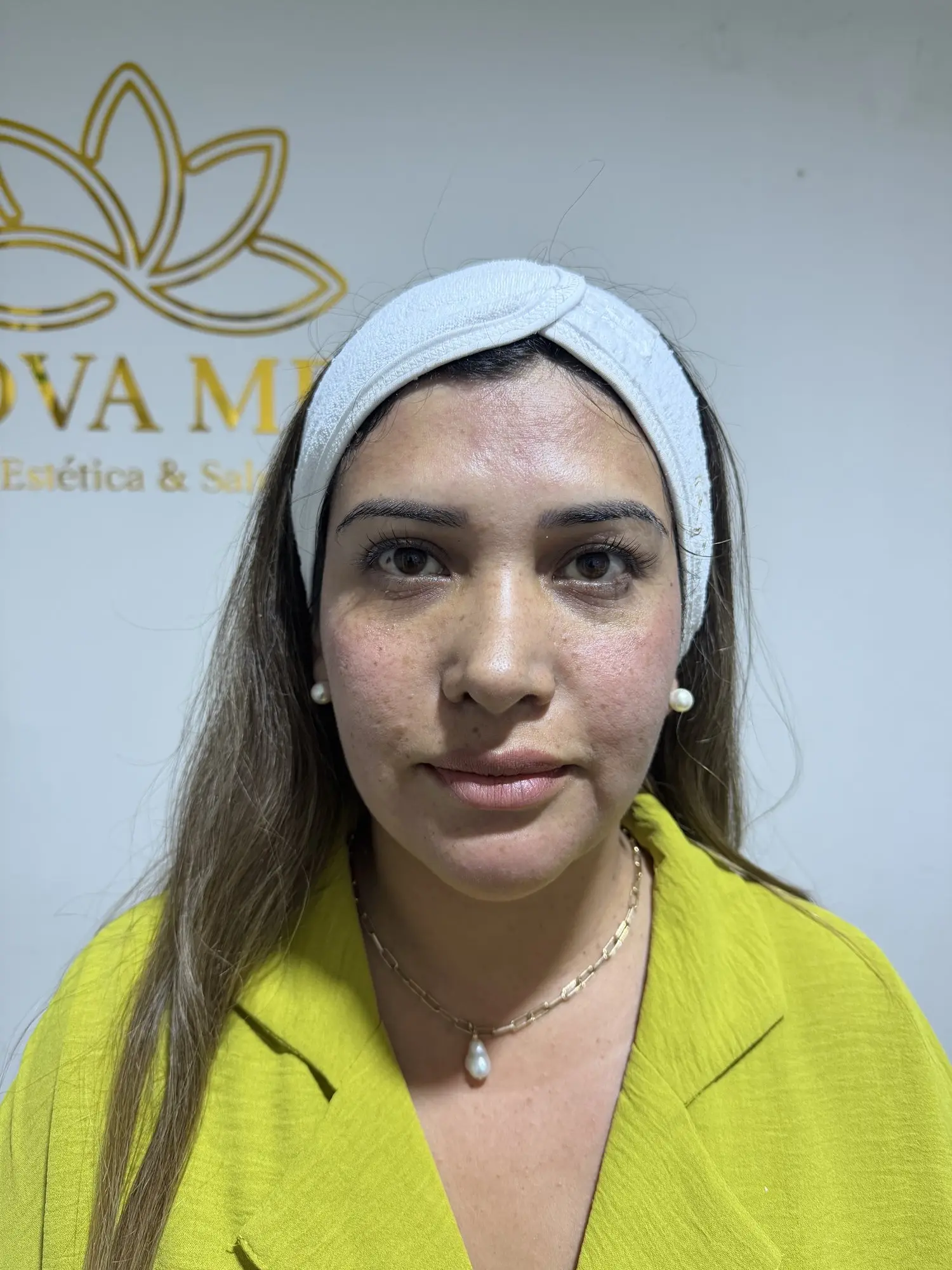 Morpheus facial: después del tratamiento